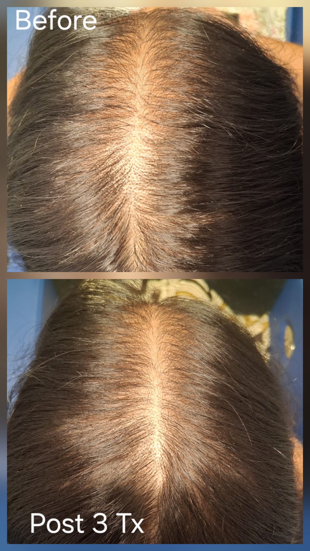 Hair restoration result